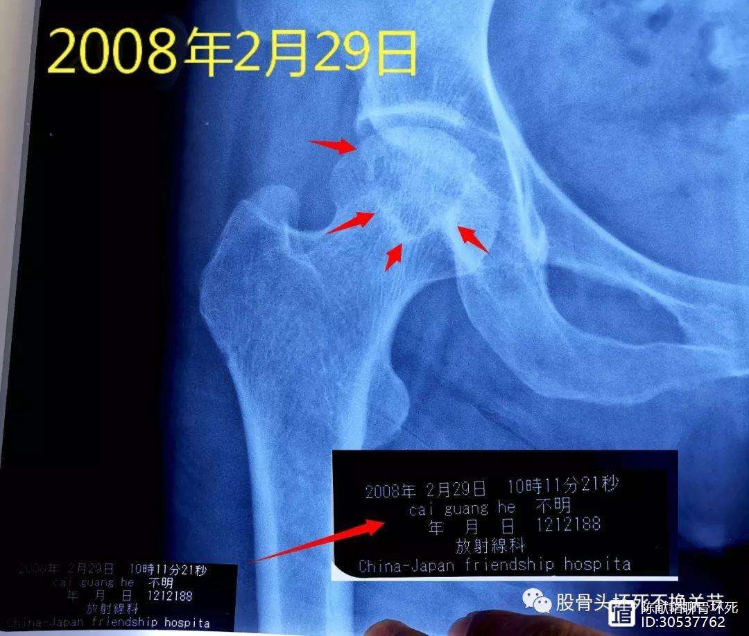 泉州人工骨头医保报销多少(人工骨头医保报销多少比例)